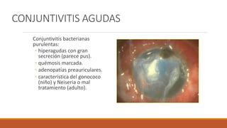 CONJUNTIVITIS AGUDAS
Conjuntivitis bacterianas
purulentas:
◦ hiperagudas con gran
secreción (parece pus).
◦ quémosis marca...