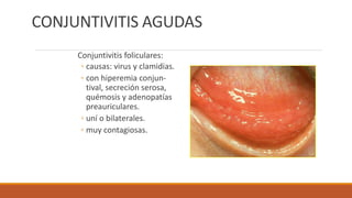 CONJUNTIVITIS AGUDAS
Conjuntivitis foliculares:
◦ causas: virus y clamidias.
◦ con hiperemia conjun-
tival, secreción sero...