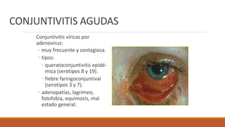 CONJUNTIVITIS AGUDAS
Conjuntivitis víricas por
adenovirus:
◦ muy frecuente y contagiosa.
◦ tipos:
◦ queratoconjuntivitis e...
