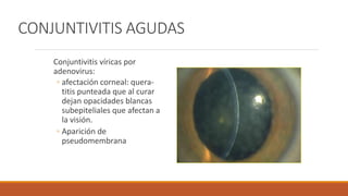 CONJUNTIVITIS AGUDAS
Conjuntivitis víricas por
adenovirus:
◦ afectación corneal: quera-
titis punteada que al curar
dejan ...