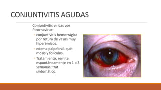 CONJUNTIVITIS AGUDAS
Conjuntivitis víricas por
Picornavirus:
◦ conjuntivitis hemorrágica
por rotura de vasos muy
hiperémic...