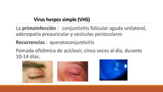 Virus herpes simple (VHS)
La primoinfección : conjuntivitis folicular aguda unilateral,
adenopatía preauricular y vesícula...