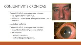 CONJUNTIVITIS CRÓNICAS
Conjuntivitis foliculares por acné rosácea:
◦ ojo rojo bilateral y continuo.
◦ pacientes con eritem...