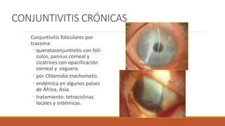 CONJUNTIVITIS CRÓNICAS
Conjuntivitis foliculares por
tracoma:
◦ queratoconjuntivitis con folí-
culos, pannus corneal y
cic...