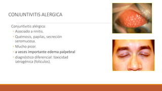 CONJUNTIVITIS ALERGICA
Conjuntivitis alérgica:
◦ Asociado a rinitis.
◦ Quémosis, papilas, secreción
seromucosa.
◦ Mucho pi...