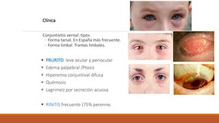 Clínica
Conjuntivitis vernal: tipos
◦ Forma tarsal. En España más frecuente.
◦ Forma limbal. Trantas limbales.
 PRURITO l...