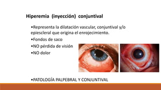 Hiperemia (inyección) conjuntival
•Representa la dilatación vascular, conjuntival y/o
epiescleral que origina el enrojecim...