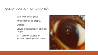 QUERATOCONJUNTIVITIS ATOPICA
Es la forma más grave
Antecedentes de atopia.
Crónica.
Mayor predisposición a herpes
simple
E...