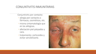 CONJUNTIVITIS INMUNITARIAS
Conjuntivitis por contacto:
◦ alergia por contacto a:
fármacos, cosméticos, etc.
◦ misma sintom...