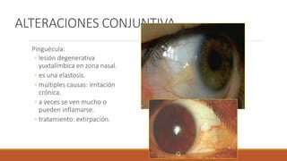 ALTERACIONES CONJUNTIVA
Pinguécula:
◦ lesión degenerativa
yuxtalímbica en zona nasal.
◦ es una elastosis.
◦ múltiples caus...