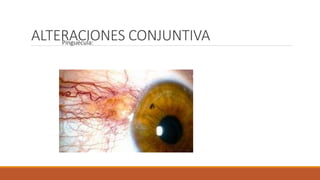 ALTERACIONES CONJUNTIVAPinguécula:
 