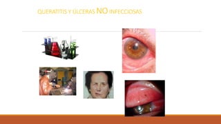 QUERATITIS Y ÚLCERAS NOINFECCIOSAS
 