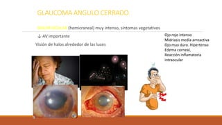 GLAUCOMA ANGULO CERRADO.
DOLOR OCULAR (hemicraneal) muy intenso, síntomas vegetativos
↓ AV importante
Visión de halos alre...