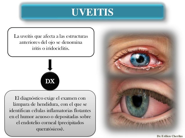 Artropatichesky la psoriasis del ungüento