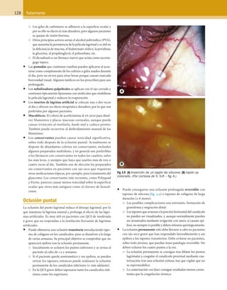 128 Tratamiento
○	 Los geles de carbómero se adhieren a la superficie ocular y
por su ello su efecto es más duradero, pero algunos pacientes
se quejan de visión borrosa.
○	 Otros principios activos serían el alcohol polivinílico (PVA),
que aumenta la persistencia de la película lagrimal y es útil en
la deficiencia de mucina, el hialuronato sódico, la povidona,
la glicerina, el propilenglicol, el polisorbato, etc.
○	 El dicuafosol es un fármaco nuevo que actúa como secreta-
gogo tópico.
•	 Las pomadas que contienen vaselina pueden aplicarse al acos-
tarse como complemento de los colirios o geles usados durante
el día, pero no sirven para otras horas porque causan marcada
borrosidad visual. Algunos médicos no los prescriben para uso
prolongado.
•	 Los nebulizadores palpebrales se aplican con el ojo cerrado y
contienen típicamente liposomas con moléculas que estabilizan
la película lagrimal y reducen la evaporación.
•	 Los insertos de lágrima artificial se colocan una o dos veces
al día y ofrecen un efecto terapéutico duradero, por lo que son
preferidos por algunos pacientes.
•	 Mucolíticos. El colirio de acetilcisteína al 5% sirve para disol-
ver filamentos y placas mucosas corneales, aunque puede
causar irritación al instilarla, huele mal y caduca pronto.
También puede recurrirse al desbridamiento manual de los
filamentos.
•	 Los conservantes pueden causar toxicidad significativa,
sobre todo después de la oclusión puntal. Actualmente se
dispone de abundantes colirios sin conservantes, incluidos
algunos preparados multidosis, y en general son preferibles
a los fármacos con conservantes en todos los cuadros, salvo
los más leves, y siempre que haya que usarlos más de tres o
cuatro veces al día. También son de elección los preparados
sin conservantes en pacientes con ojo seco que requieran
otras medicaciones tópicas, por ejemplo, para tratamiento del
glaucoma. Los conservantes más recientes, como Polyquad
y Purite, parecen causar menos toxicidad sobre la superficie
ocular que otros más antiguos como el cloruro de benzal-
conio.
Oclusión puntal
La oclusión del punto lagrimal reduce el drenaje lagrimal, por lo
que mantiene la lágrima natural y prolonga el efecto de las lágri-
mas artificiales. Es muy útil en pacientes con QCS de moderada
a grave que no respondan a la instilación frecuente de lágrimas
artificiales.
•	 Puede obtenerse una oclusión transitoria introduciendo tapo-
nes de colágeno en los canalículos, pues se disuelven a lo largo
de varias semanas. Su principal objetivo es comprobar que no
aparecerá epífora tras la oclusión permanente.
○	 Inicialmente se ocluyen los puntos inferiores y se revisa al
paciente al cabo de 1 o 2 semanas.
○	 Si el paciente queda asintomático y sin epífora, se pueden
retirar los tapones; entonces puede realizarse la oclusión
permanente de los canalículos inferiores (v. más adelante).
○	 En la QCS grave deben taponarse tanto los canalículos infe-
riores como los superiores.
•	 Puede conseguirse una oclusión prolongada reversible con
tapones de silicona (fig. 4.9) o tapones de colágeno de larga
duración (2-6 meses).
○	 Las posibles complicaciones son extrusión, formación de
granuloma y migración distal.
○	 Los tapones que avanzan a la porción horizontal del canalículo
no pueden ser visualizados, y, aunque normalmente pueden
ser arrastrados mediante irrigación con suero, si causan epí-
fora, no siempre es posible y deben retirarse quirúrgicamente.
•	 La oclusión permanente solo debe llevarse a cabo en pacientes
con ojo seco grave que han respondido favorablemente y sin
epífora a los tapones transitorios. Debe evitarse en pacientes,
sobre todo jóvenes, que puedan tener patología reversible. No
deben ocluirse los cuatro puntos a la vez.
○	 La oclusión permanente se consigue tras dilatar los puntos
lagrimales y coagular el canalículo proximal mediante cau-
terización; tras una oclusión exitosa, hay que vigilar que no
se repermeabilice.
○	 La cauterización con láser consigue resultados menos consis-
tentes que la coagulación térmica.
Fig. 4.9  (A) Inserción de un tapón de silicona; (B) tapón ya
colocado. (Por cortesía de S. Tuft – fig. A.)
ERRNVPHGLFRVRUJ
 