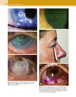126 Pruebas complementarias
Fig. 4.7  Complicaciones corneales graves en el ojo seco.
(A) Lisis corneal; (B) perforación taponada por el iris;
(C) infección bacteriana.
Fig. 4.8  Pruebas diagnósticas en el ojo seco. (A) Tiempo
de rotura de la película lagrimal: aparecen numerosos
puntos de desecación en la película lagrimal teñida con
fluoresceína; (B) prueba de Schirmer; (C) tinción corneal
y conjuntival con rosa de Bengala.
ERRNVPHGLFRVRUJ
 