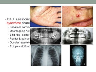 • OKC is associated with GORLIN-GOLTZ (NBSCS)
syndrome characterized by;
• Basal cell carcinoma
• Odontogenic Keratocyst of the jaws
• Bifid ribs– sixth rib
• Plantar & palmar pits
• Occular hypertelorism
• Ectopic calcifications
 