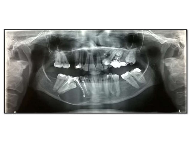 Odontogenic keratocyst