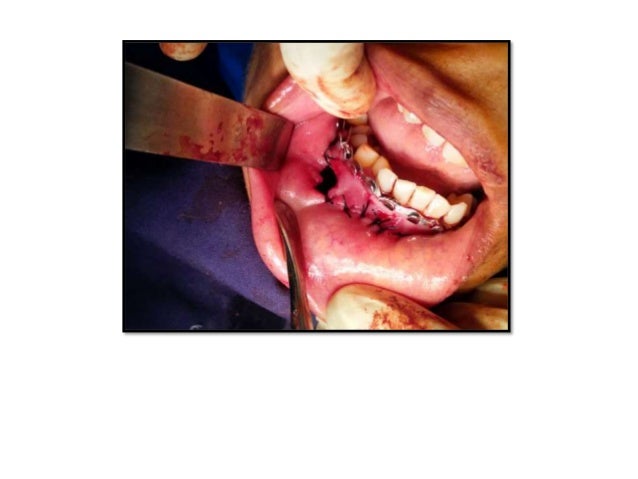 odontogenic keratocyst odontogenic keratocyst