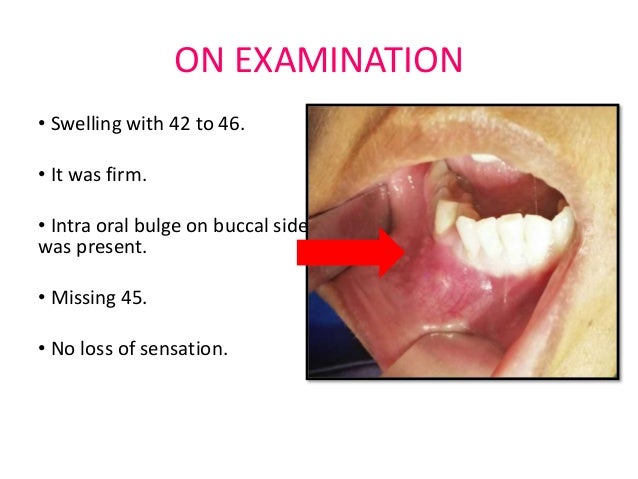 odontogenic keratocyst odontogenic keratocyst