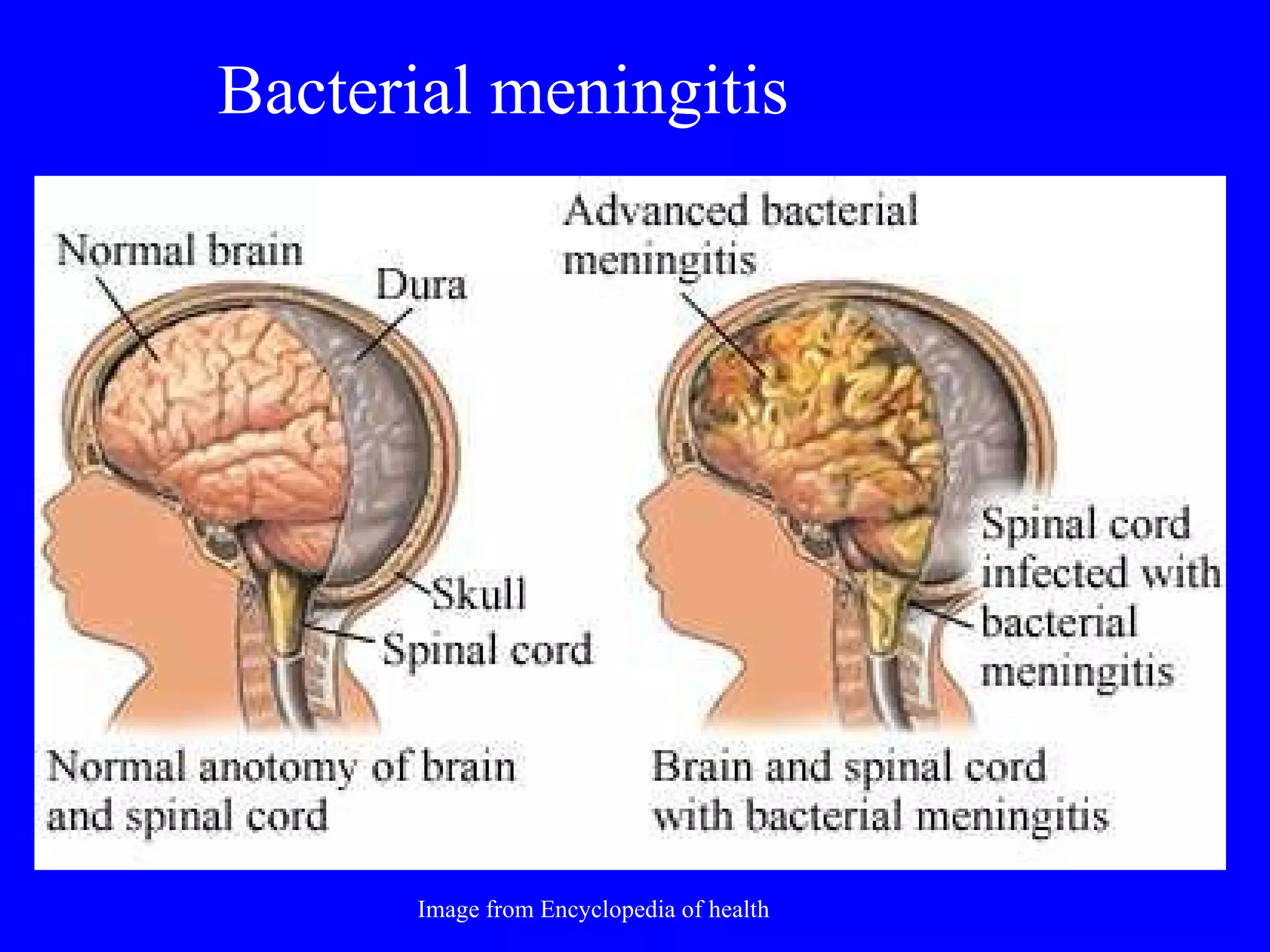 Bacterial meningitis Image from Encyclopedia of health 
