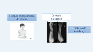 Fractura Supracondílea
do Úmero
Cotovelo
Flutuante
Fracturas do
Antebraço
 