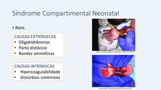 Síndrome Compartimental Neonatal
• Raro.
CAUSAS EXTRÍNSECAS
• Oligohidrâmnios
• Parto distócico
• Bandas amnióticas
CAUSAS INTRÍNSICAS
• Hipercoagulabilidade
• Distúrbios sistémicos
 