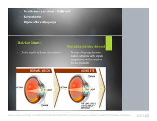 • Strabizam – razrokost – škiljavost
• Keratokonus
• Dijabetička retinopatija
Dalekovidnost
• Zrake svjetla se lome iza mrežnice
Staračka dalekovidnost
• Nastaje zbog toga što oko
nakon određene dobi izgubi
mogućnost zaoštravanja na
bliske predmete
https://cdn.fbsbx.com/v/t59.2708-21/18281881_695942740591758_414984647569152…KO-PREZENTACIJA.pptx?oh=2ae3a9a17b1adae8b19a7f1075d01ee1&oe=591D3B93&dl=1 16.05.2017. 19S26
Stranica 15 od 22
 