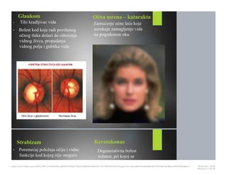 Glaukom
• Tihi kradljivac vida
• Bolest kod koje radi povišenog
očnog tlaka dolazi do oštećenja
vidnog živca, propadanja
vidnog polja i gubitka vida.
Očna mrena – katarakta
• Zamućenje očne leće koje
uzrokuje zamagljenje vida
na pogođenom oku
Strabizam
• Poremećaj položaja očiju i vidne
funkcije kod kojeg nije moguće
Keratokonus
• Degenerativna bolest
rožnice, pri kojoj se
https://cdn.fbsbx.com/v/t59.2708-21/18281881_695942740591758_414984647569152…KO-PREZENTACIJA.pptx?oh=2ae3a9a17b1adae8b19a7f1075d01ee1&oe=591D3B93&dl=1 16.05.2017. 19S26
Stranica 17 od 22
 