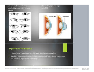 obje vidne linije istodobno
usmjeriti prema točki koja se
fiksira
rožnica stanjuje i mijenja
svoj oblik
Dijabetička retinopatija
• Jedan je od vodećih uzroka sljepoće u savremenom svijetu
• Osobe s dijagnosticiranim dijabetesom imaju 10 do 20 puta veće šanse
da obole od dijabetičke retinopatije
https://cdn.fbsbx.com/v/t59.2708-21/18281881_695942740591758_414984647569152…KO-PREZENTACIJA.pptx?oh=2ae3a9a17b1adae8b19a7f1075d01ee1&oe=591D3B93&dl=1 16.05.2017. 19S26
Stranica 18 od 22
 