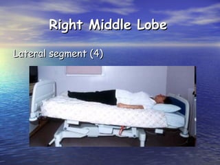 Right Middle Lobe
Lateral segment (4)

 