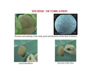 TECHNIC OF COBLATION




Position and marking of the entry point and direction of the disk of interest




     Local anesthesia                                Incision of the skin
 