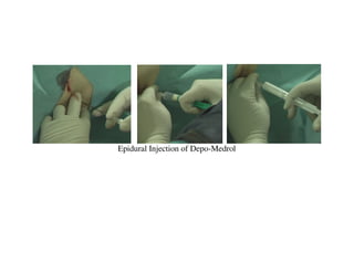Epidural Injection of Depo-Medrol
 