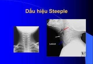 Dấu hiệu Steeple
 