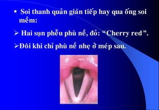  Soi thanh quaûn giaùn tieáp hay qua oáng soi
meàm:
 Hai suïn pheãu phuø neà, ñoû: “Cherry red”.
Ñoâi khi chæ phuø neà nheï ôû meùp sau.
 