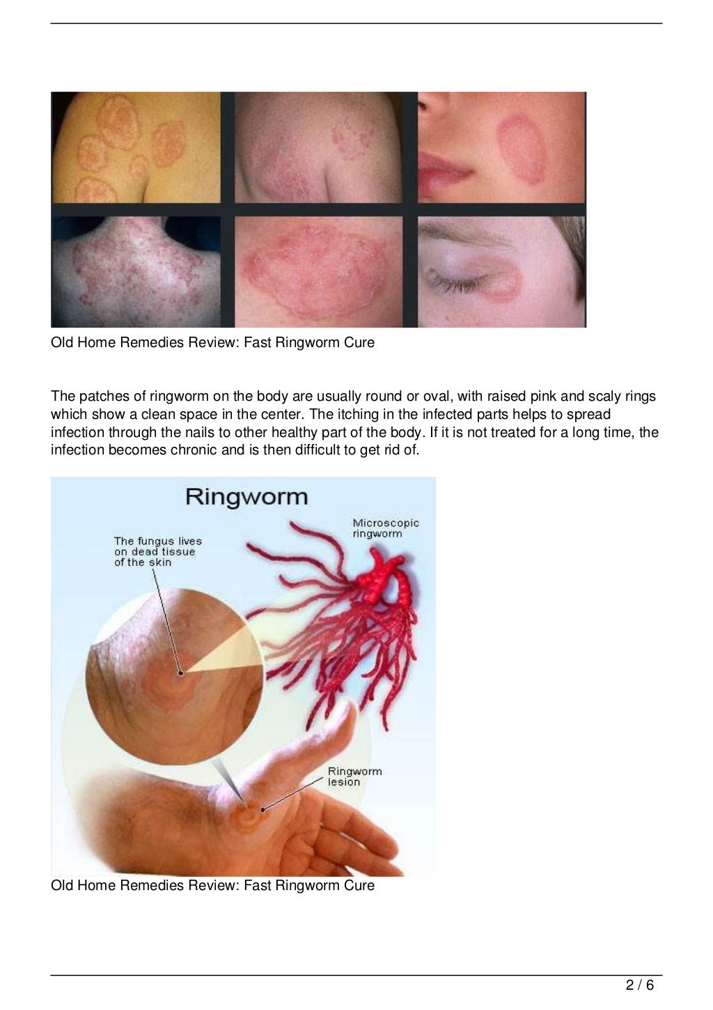 Old Home Remedies Review Fast Ringworm Cure