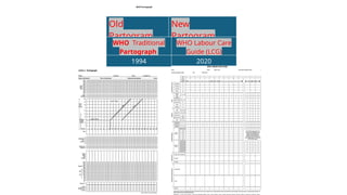 WHO Partograph
Old
Partogram
New
Partogram
WHO Traditional
Partograph
WHO Labour Care
Guide (LCG)
1994 2020
 