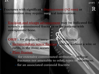 Fractures with significan t  displacement (>2 mm)  or comminution may require  surg ical intervention. Excision and triceps advancement   may be indicated for severely comminuted fractu r es or for patients with osteoporotic bone.  ORIF  -  for displaced intra-  articu lar fractures.  Intramedullary screw fixation ,  with or without a wire or cable, is the most secure. Plate fixation for extensive comminuted or unstable  oblique  fractures not amenable to other types of  treatment. for an associated coronoid fracture 