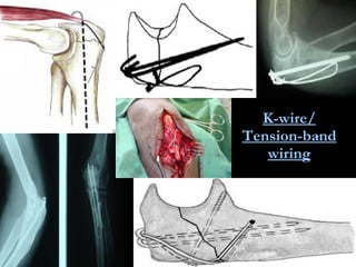 K-wire/ Tension-band wiring 