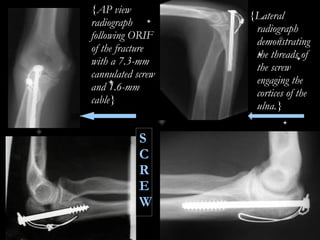 {AP view radiograph following ORIF of the fracture with a 7.3-mm cannulated screw and 1.6-mm cable} {Lateral radiograph demonstrating the threads of the screw engaging the cortices of the ulna.} S C R E W 