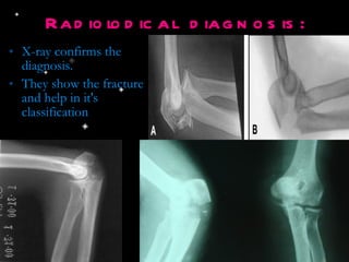 Radiolodical diagnosis: X-ray confirms the diagnosis. They show the fracture and help in it's classification 