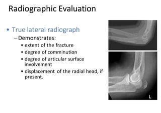 Radiographic Evaluation
• True lateral radiograph
Demonstrates:
• extent of the fracture
• degree of comminution
• degree of articular surface
involvement
• displacement of the radial head, if
present.
 