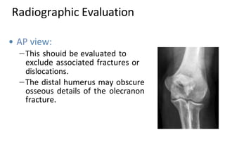 • AP view:
This shouid be evaluated to
exclude associated fractures or
dislocations.
The distal humerus may obscure
osseous details of the olecranon
fracture.
Radiographic Evaluation
 