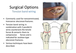 Surgical Options
Tension band wiring
• Commonly used for noncomminuted,
transverse olecranon fractures.
• Tension band wiring in
combination with 2 parallel K-
wires counteracts the tensile
forces & converts them to
compressive forces and is
indicated for avulsion-type
olecranon fractures.
• Various techniques have been
described.
 