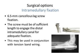 Surgical options
Intramedullary fixation
• 6.5-mm cancellouslag screw
fixation.
• The screw must be of sufficient
length to engage the distal
intramedullary canal for
adequate fixation.
• This may be used in conjunction
with tension band wiring.
*
*
*
,
«g%•- "*
 