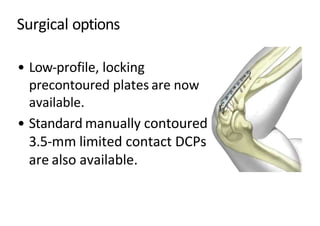 Surgical options
• Low-profile, locking
precontoured plates are now
available.
• Standard manually contoured
3.5-mm limited contact DCPs
are also available.
 