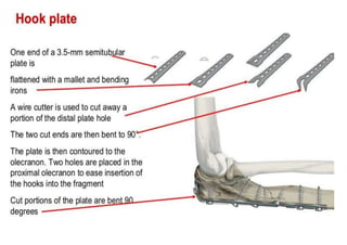 Hook plate
One end of a 3.5-mm semitubular
Plate
flattened with a mallet and bendïng
irons
A wire cutter is used to cut away a
portion of the distal plate hole
The two cut ends are then bent to 90’“.
The plate is then contoured to the
olecranon. Two holes are placed in the
proximal olecranon to ease insertion of
the hooks into the fragments
Cut portions of the plate are
bent to 90 degrees
 