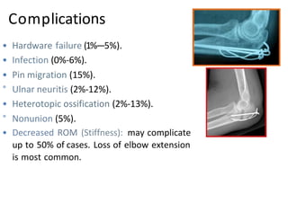 Complications
• Hardware failure (1%—5%).
• Infection (0%-6%).
• Pin migration (15%).
° Ulnar neuritis (2%-12%).
• Heterotopic ossification (2%-13%).
° Nonunion (5%).
• Decreased ROM (Stiffness): may complicate
up to 50% of cases. Loss of elbow extension
is most common.
 