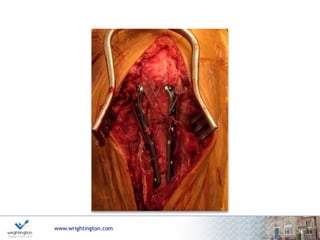 Isolated Olecranon Fracture
www.wrightington.com
37
Super elderly /
Low demand?
Dementia?
Unfit?
Non-operative
Is ulnohumeral joint stable?
Simple transverse/
stable oblique
Suture repair
Comminuted
YES NO
Plate Fixation
(+/- suture repair)
 