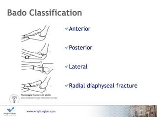 www.wrightington.com
Jupiter Classification of Type II
Fractures
IIa Coronoid level
IIb Metaphyseal/
Diaphyseal junction
IIc Distal to coronoid
IId Fracture extending to
distal 1/2 ulna
40
 